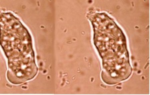 Amoebiasis