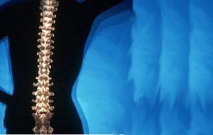 Osteoporosis