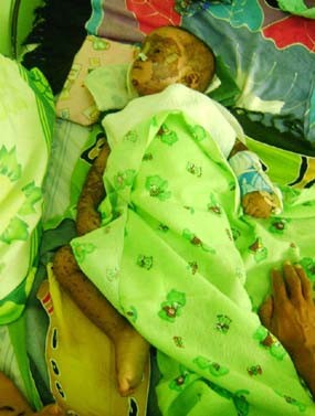 Diduga Alergi Obat, Sekujur Tubuh Rizki Melepuh