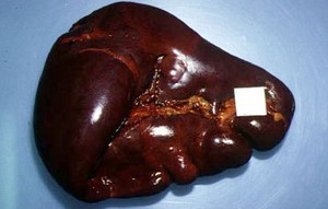 Myelofibrosis Utama