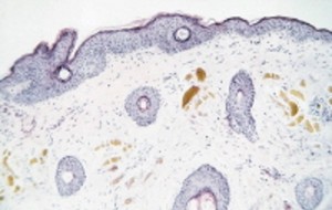 Alkaptonuria