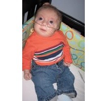 Vonis Mati Bayi Trisomi 18