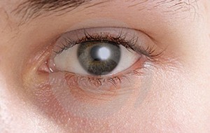 Kojungtivitis Vernal