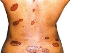 Sarcoidosis