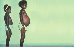 Schistosomiasis