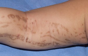 Incontinentia pigmenti