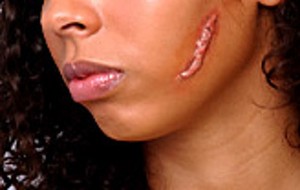  Keloid