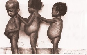 Kwashiorkor