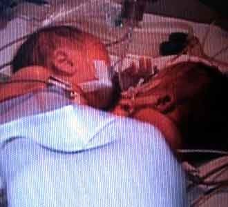 Seorang Bayi Kembar Siam Meninggal
