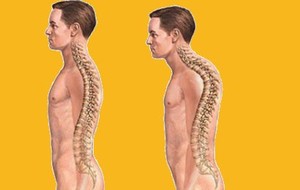 Kyphosis