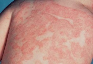 Wanita Berisiko Alami Alergi Obat dan Kulit Melepuh