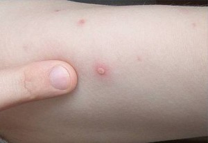 Menangani Anak yang Kena Cacar Air