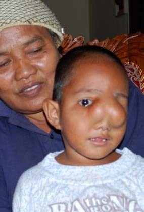 Kelainan Sejak Lahir, Bocah 2 Tahun Mengaku Nyeri Tiap Hari