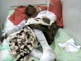 Terhimpit Bara Api 30 Menit, Tubuh Supla Melepuh