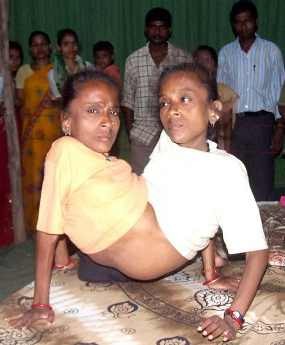 Si Kembar Laba-laba dari India, Berjuang Demi Hidupi Keluarga