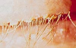Meibomianitis