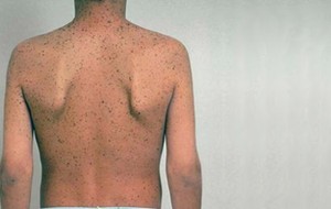 Multiple lentigines syndrome