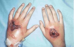 Mucormycosis