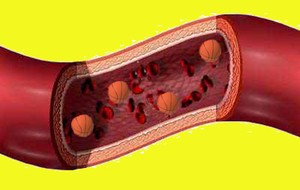  Thrombosis vena mesenterika