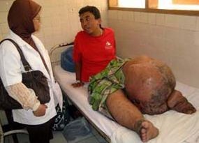 Minum Obat Kaki Gajah, Ratusan Warga Majalaya Dilarikan ke RS 