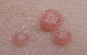 Molluscum Contagiosum