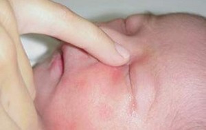 Neonatal Conjunctivitis