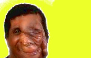 Neurofibromatosis-1