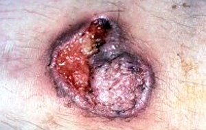 Infeksi Nocardia