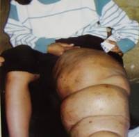 Nyamuk Kaki Gajah Senang Menyerang Kelamin Pria