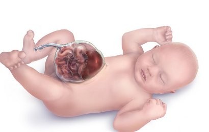 Omphalocele