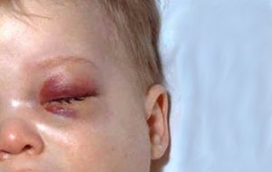Orbital Selulitis