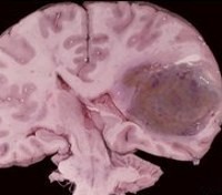 Gen Penyebab Tumor Otak Ditemukan