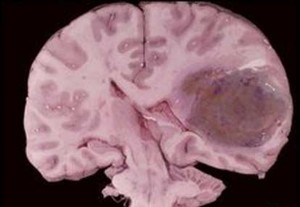 Gen Penyebab Tumor Otak Ditemukan