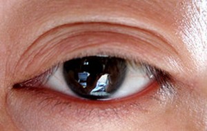 Orbital Pseudotumor