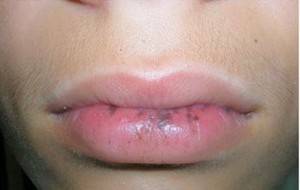  Osler-Weber-Rendu Syndrome