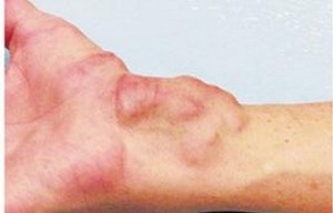  Osteitis Fibrosa