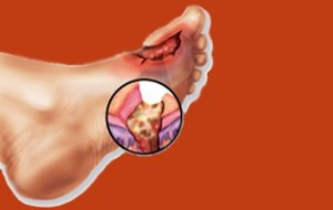 Osteomyelitis