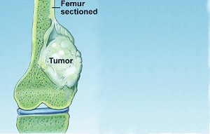 Osteosarcoma
