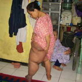 Alma: Bandung Berpotensi Jadi Daerah Endemis Filariasis