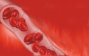 Pernicious Anemia