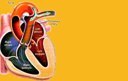 Patent ductus arteriosus PDA  