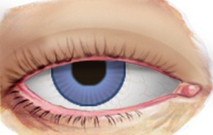Ptosis