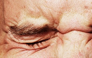 Parinaud Syndrome