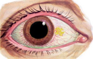 Pinguecula