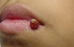 Piogenik Granuloma