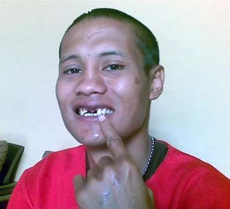 Dihantam Botol, Gigi Petinju Rontok