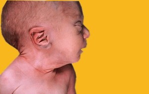 Potter Syndrome