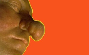 Rhinophyma