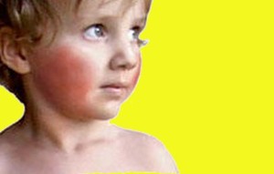 Roseola