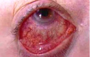 Scleritis